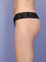 Liposuction Before and after photo