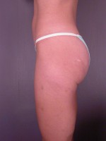 Liposuction Before and after photo