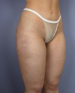 Liposuction Before and after photo