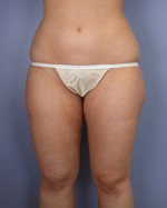 Liposuction