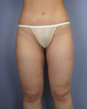 Liposuction before and after photo