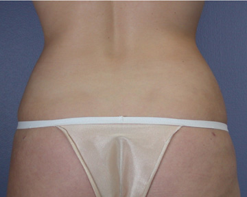 Liposuction before and after photo