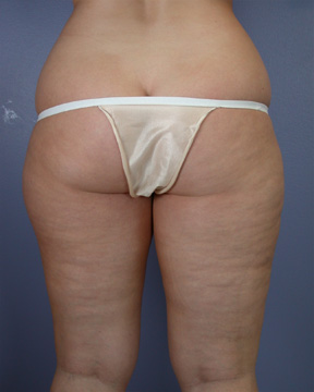 Liposuction before and after photo