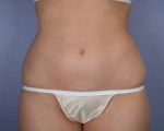 Liposuction Before and after photo