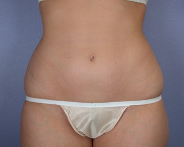 Liposuction before and after photo