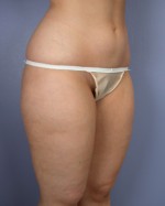 Liposuction Before and after photo