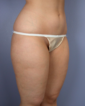 Liposuction before and after photo