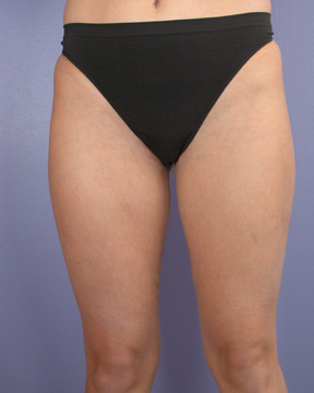 Liposuction before and after photo