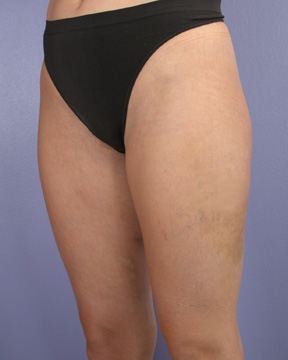 Liposuction before and after photo