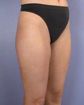 Liposuction before and after photo