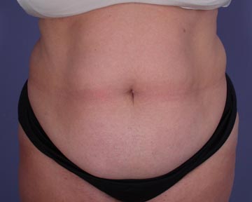 Liposuction before and after photo