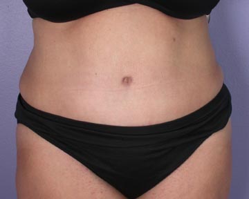 Liposuction before and after photo