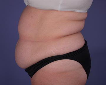 Liposuction before and after photo