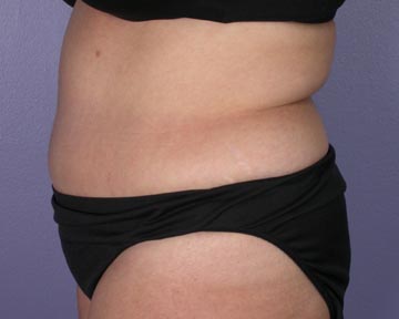 Liposuction before and after photo