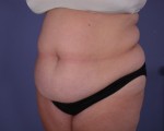 Liposuction Before and after photo