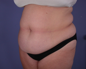 Liposuction before and after photo