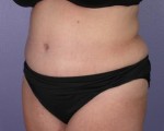 Liposuction Before and after photo