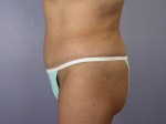 Liposuction Before and after photo