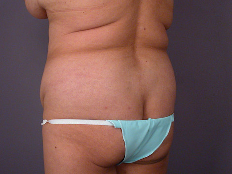 Liposuction before and after photo