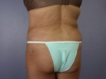 Liposuction Before and after photo