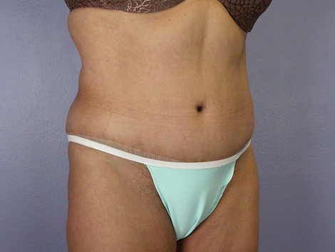 Liposuction before and after photo