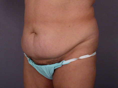 Liposuction before and after photo