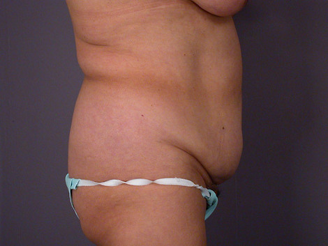 Liposuction before and after photo