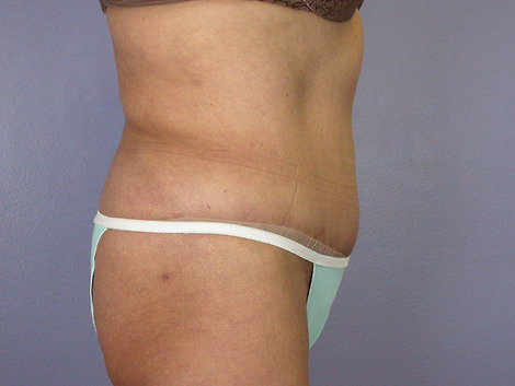 Liposuction before and after photo