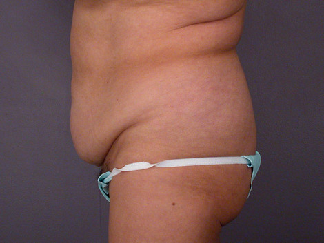 Liposuction before and after photo