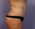 Liposuction Before and after photo