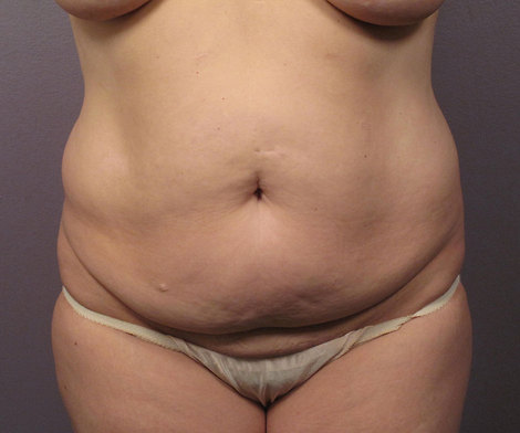 Liposuction before and after photo