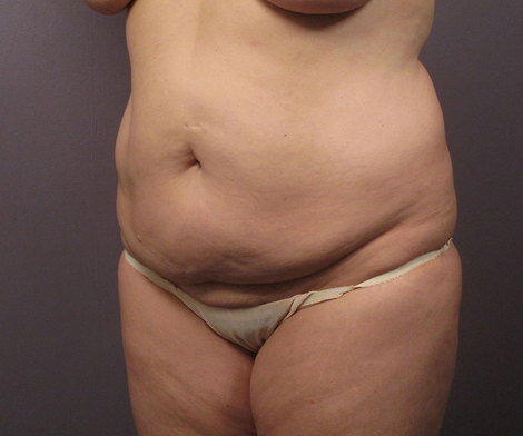 Liposuction before and after photo