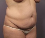 Liposuction Before and after photo