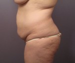 Liposuction Before and after photo