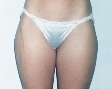 Liposuction before and after photo