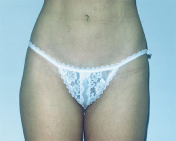 Liposuction before and after photo