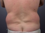 Liposuction Before and after photo