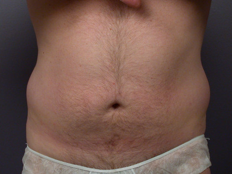 Liposuction before and after photo