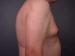 Liposuction Before and after photo