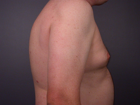 Liposuction before and after photo