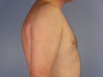 Liposuction Before and after photo