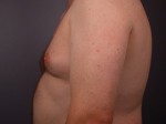 Liposuction Before and after photo