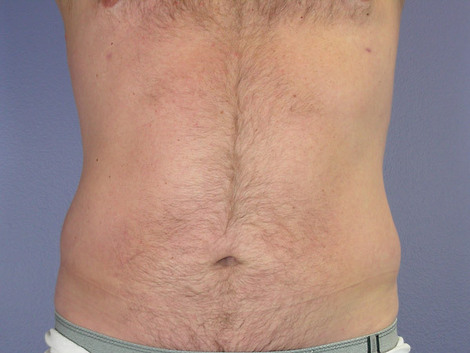 Liposuction before and after photo