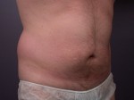 Liposuction