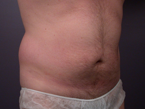 Liposuction before and after photo