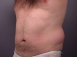 Liposuction Before and after photo