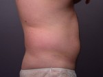 Liposuction Before and after photo