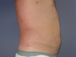 Liposuction Before and after photo