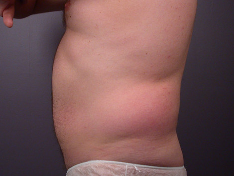 Liposuction before and after photo