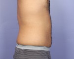 Liposuction Before and after photo